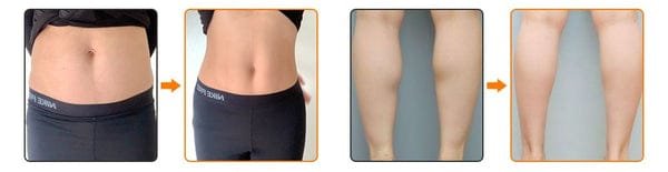 Masseur Anti-cellulite Pour Une Peau Visiblement Plus Lisse 1 avant apres minceur femme ems