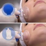 ventouses en verre pour tonifier votre peau et rajeunir visage 895 1